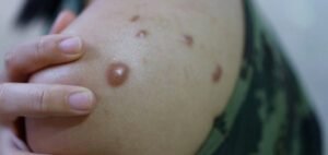 Monkeypox Virus: WHO ने Monkeypox को वैश्विक स्वास्थ्य आपातकाल किया घोषित, हो सकती है अगली घातक महामारी, जानें कारण, लक्षण और उपचार