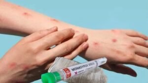 Monkeypox Virus In India: भारत में पहली बार एमपॉक्स स्ट्रेन से हड़कंप, WHO ने जारी किया अलर्ट, जानें लक्षण और बचाव के उपाय