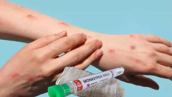 Monkeypox Virus In India: भारत में पहली बार एमपॉक्स स्ट्रेन से हड़कंप, WHO ने जारी किया अलर्ट, जानें लक्षण और बचाव के उपाय Monkeypox Virus In India: भारत में पहली बार एमपॉक्स स्ट्रेन से हड़कंप, WHO ने जारी किया अलर्ट, जानें लक्षण और बचाव के उपाय