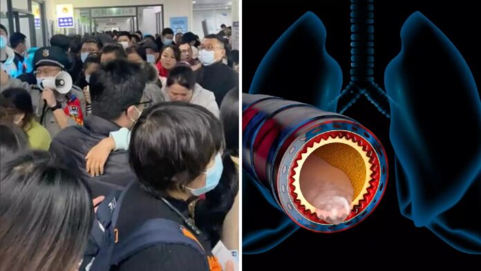 China में बढ़े मानव Metapneumovirus (HMPV) के मामले, जाने क्या है HMPV, लक्षण और इसके इलाज